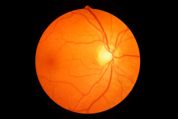 人类视盘，视网膜血管