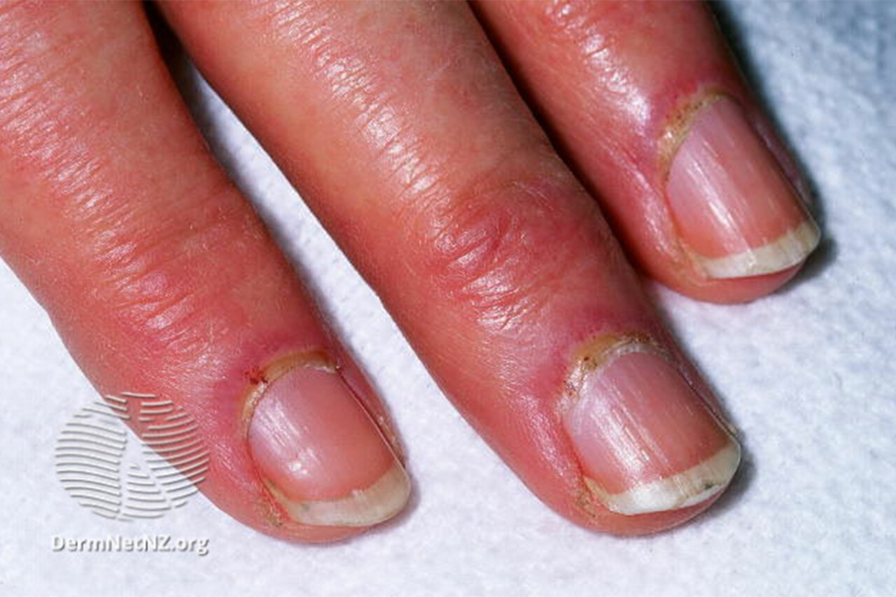 S'pore Woman Has Allergic Reaction To Gel Manicure, Warns Others To Be  Careful