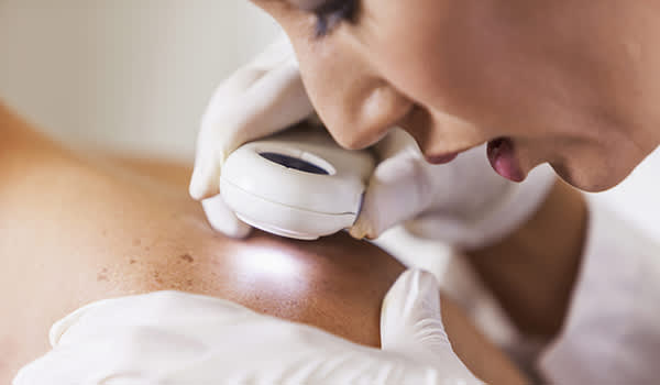 皮肤科医生搜索为皮肤癌的征兆。