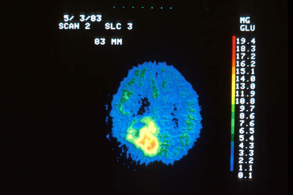 脑部肿瘤的正子断层扫描