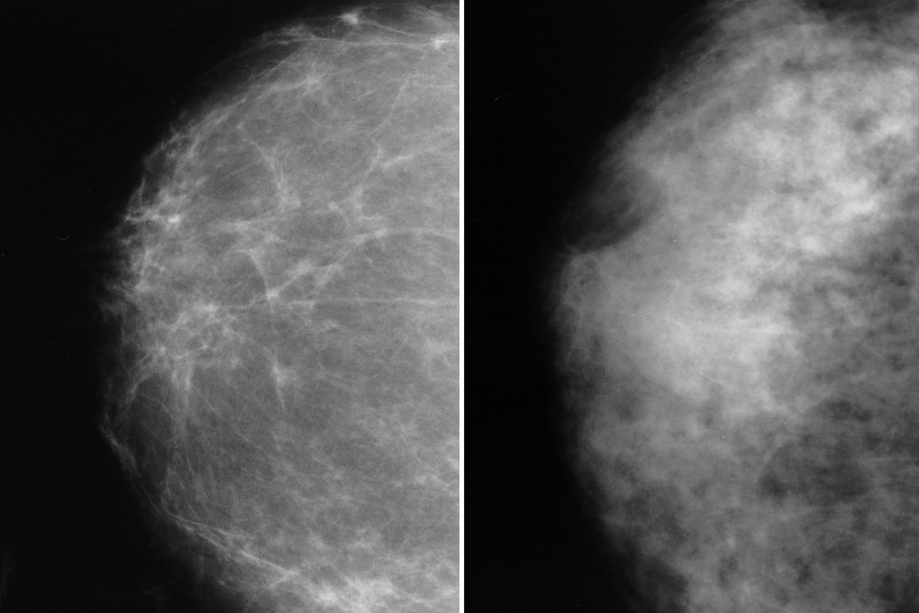 Do dense breasts affect the risk of developing breast cancer?