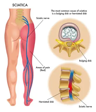 Sciatica - Symptoms and causes - Mayo Clinic