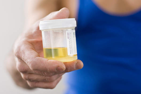 手拿一个尿液收集容器。