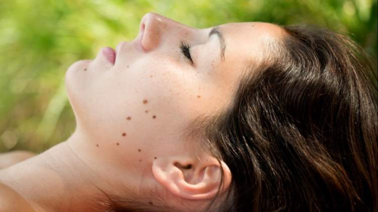 Woman with moles on her face