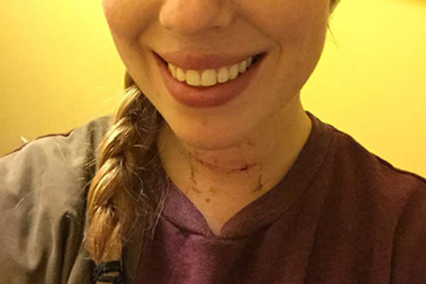 卡琳的甲状腺疤痕。