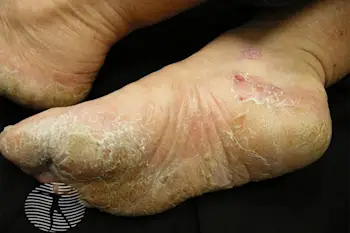A view of psoriasis on feet