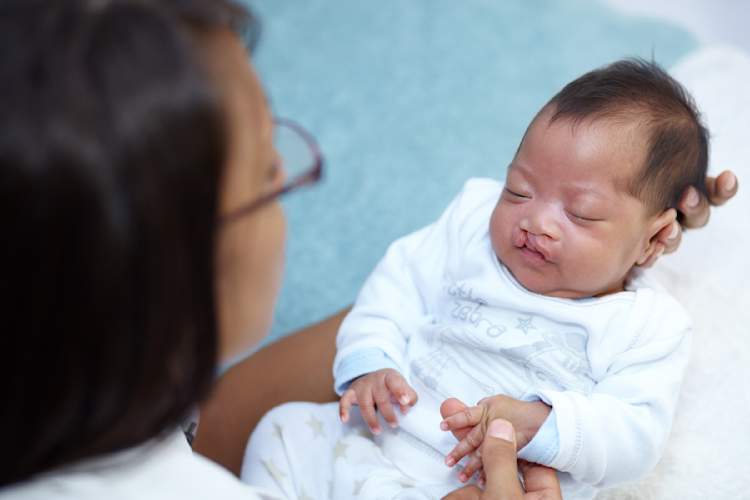 有兔唇的婴儿