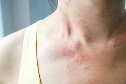 脖子上有荨麻疹的女人。