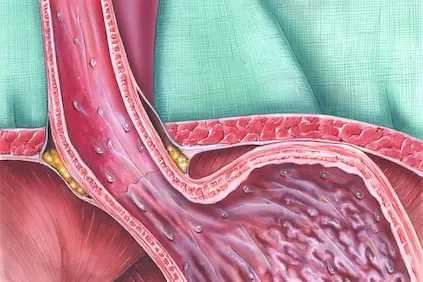 Gastroesophageal Junction Cancers What You Should Know
