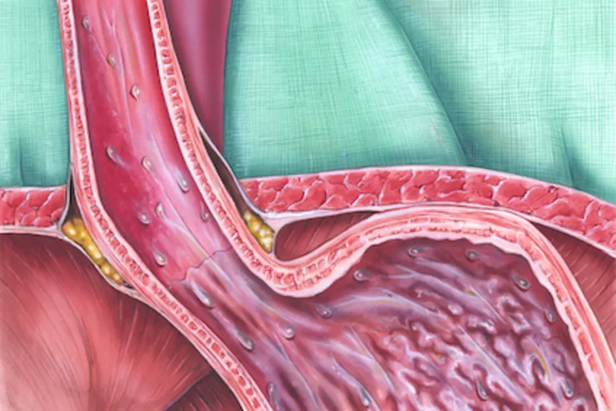 Gastroesophageal Junction Cancers What You Should Know Gastroesophageal Junction Cancers What You Should Know