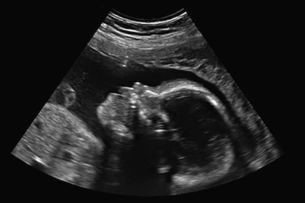 婴儿的超声