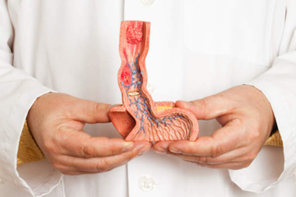 医生拿着食管的模型。