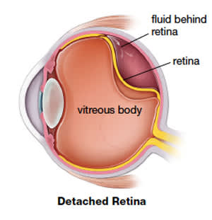 识别视网膜脱离