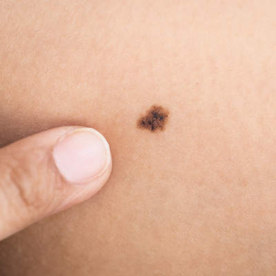Melanoma Facts 6 Things To Know