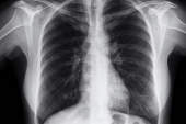 肺部的X射线