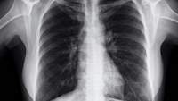 x射线的肺