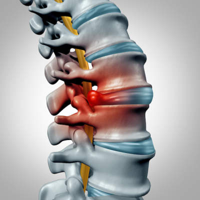 一个人的脊椎椎间盘突出例证。