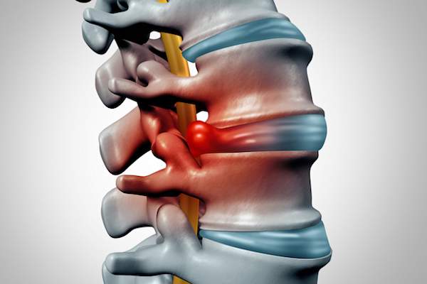 一个人的脊椎椎间盘突出例证。