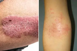 Left: Psoriasis on elbow; Right: Eczema on elbow
