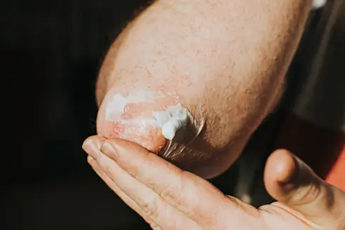A closeup of someone rubbing lotion onto an elbow with psoriasis