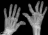 手部x光显示晚期类风湿关节炎