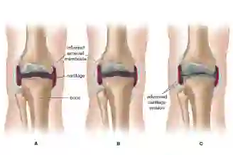 Rheumatoid arthritis joint illustration