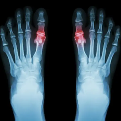 尿酸的X射线在大脚趾周围积聚