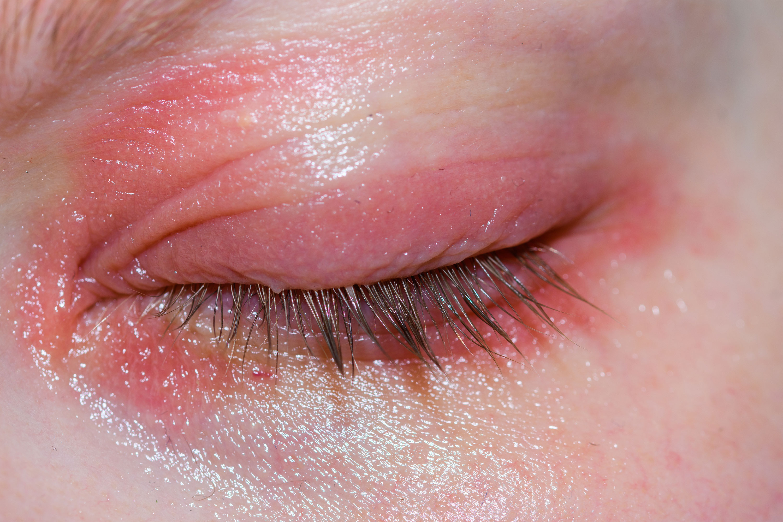 swollen dry eyelids