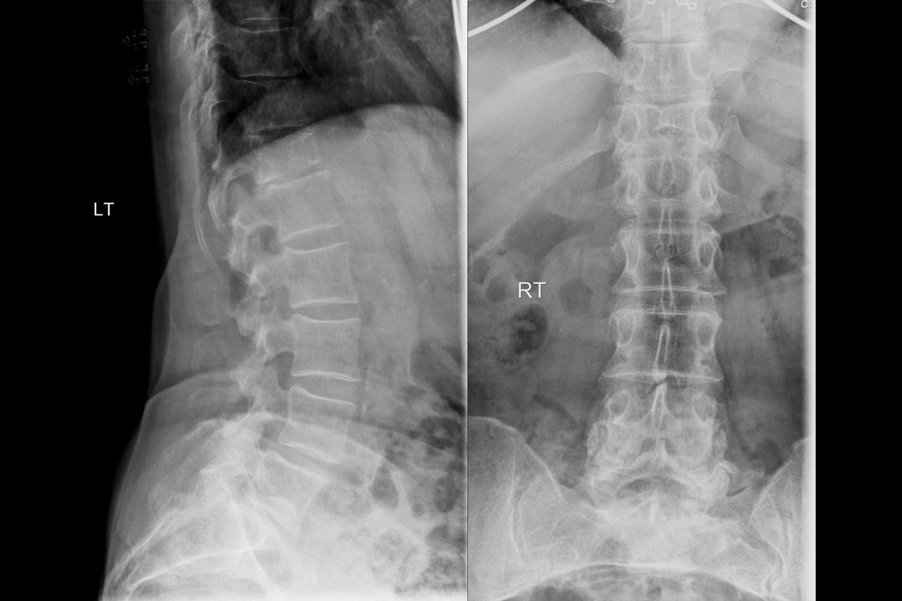 Vertebral Body and Compression Fractures