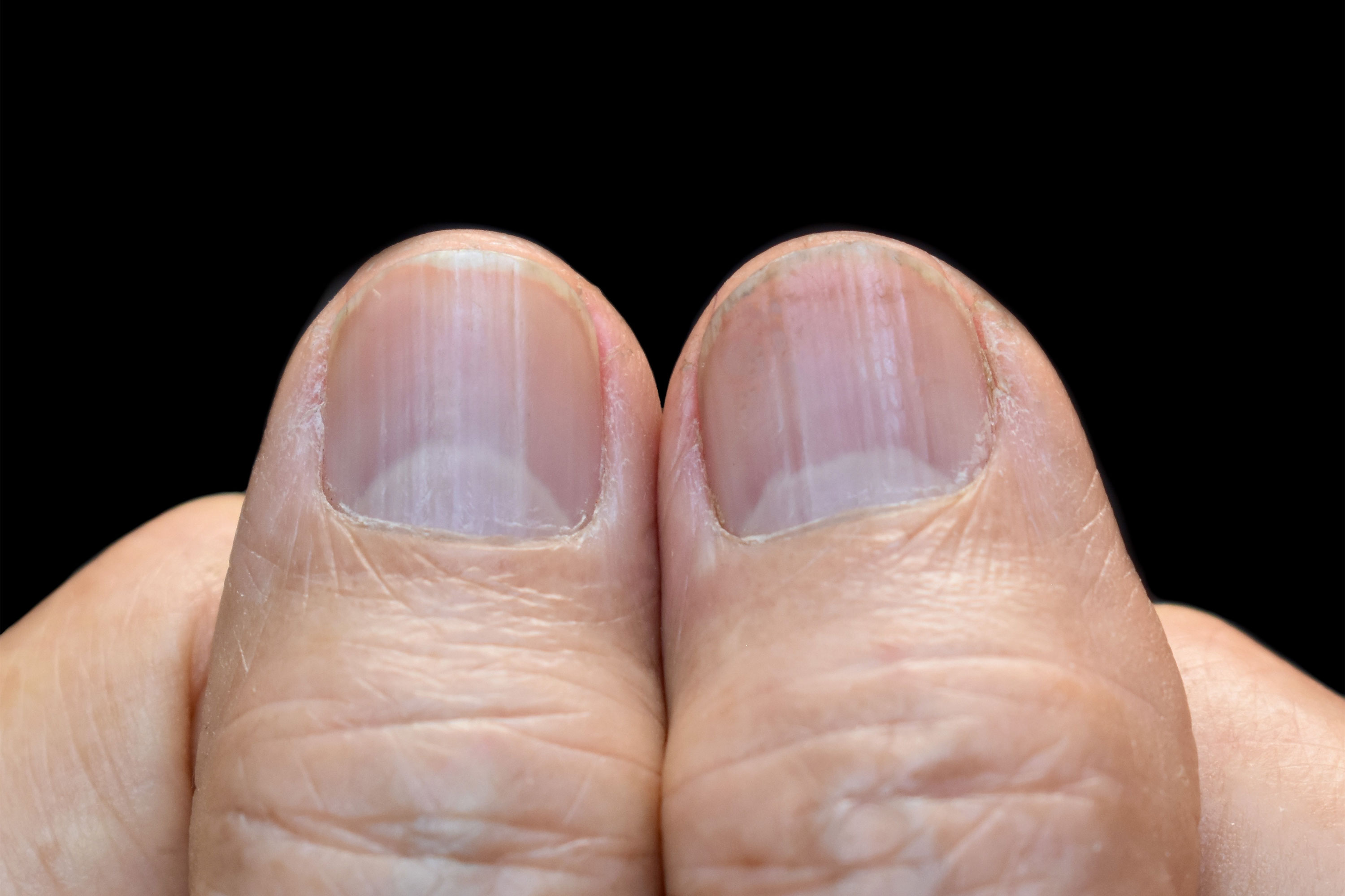6 underlying nail health problems that may mean something more