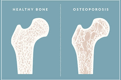 健康骨骼与骨质疏松之间的区别。