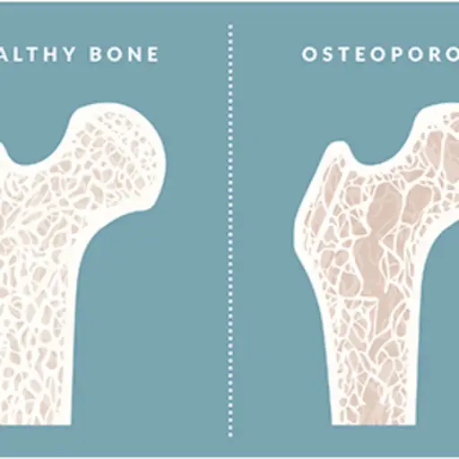 健康骨骼含有骨质疏松症的骨骼之间的差异。