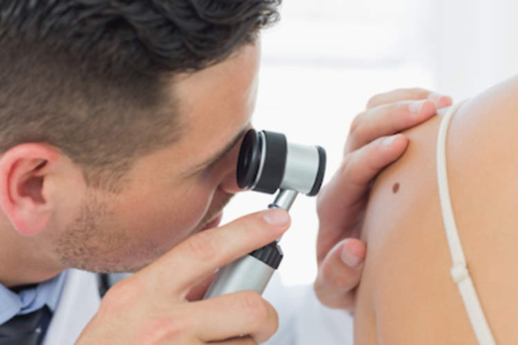 皮肤科医生检查女性的背部的痣。