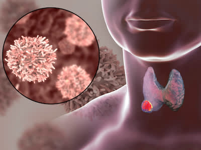 甲状腺癌，放大突变细胞。