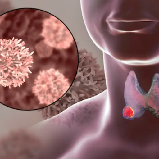 甲状腺癌，放大突变细胞。