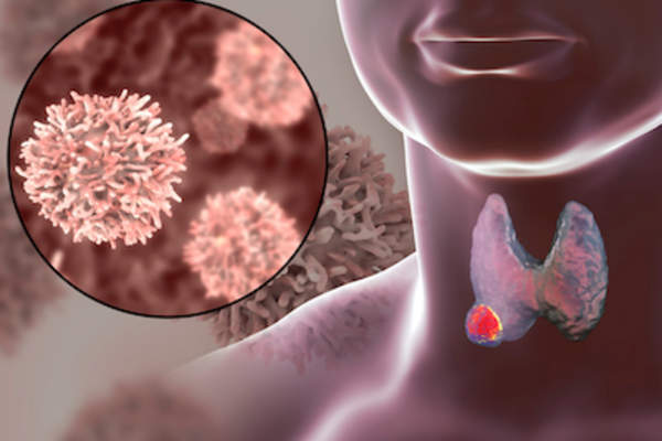 甲状腺癌,放大突变细胞。