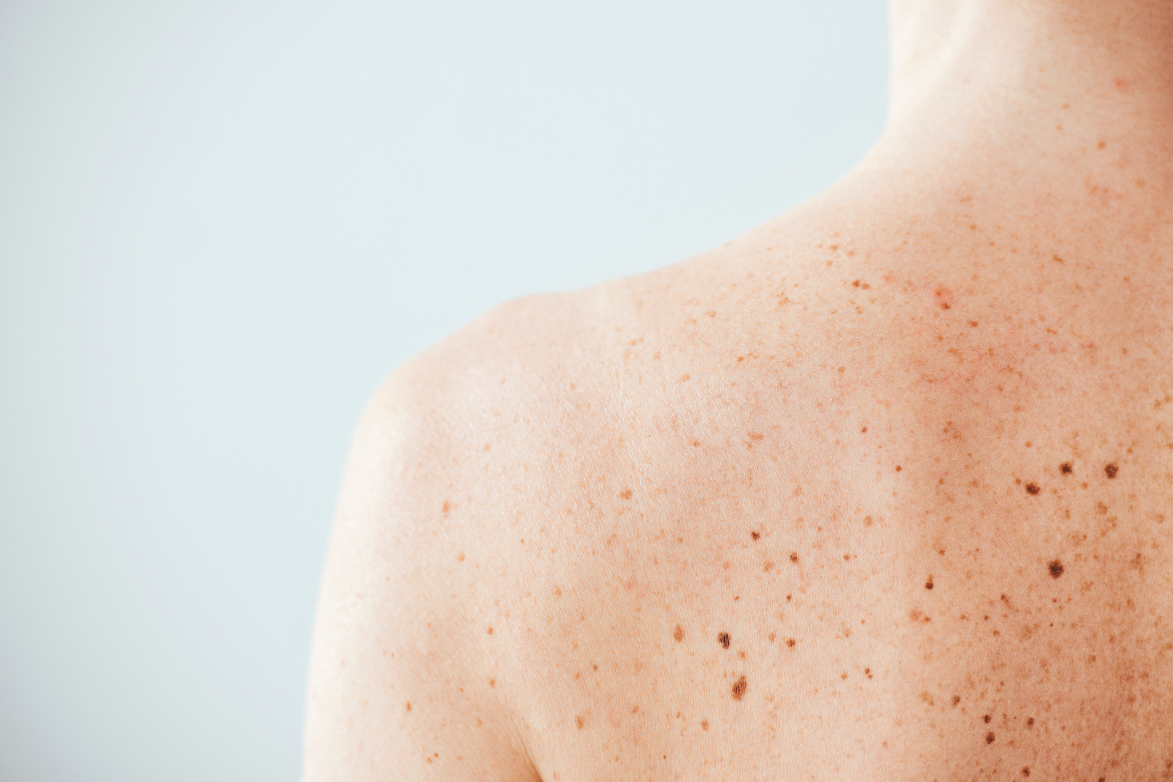 10 Ways To Tell If A Mole Is Cancerous