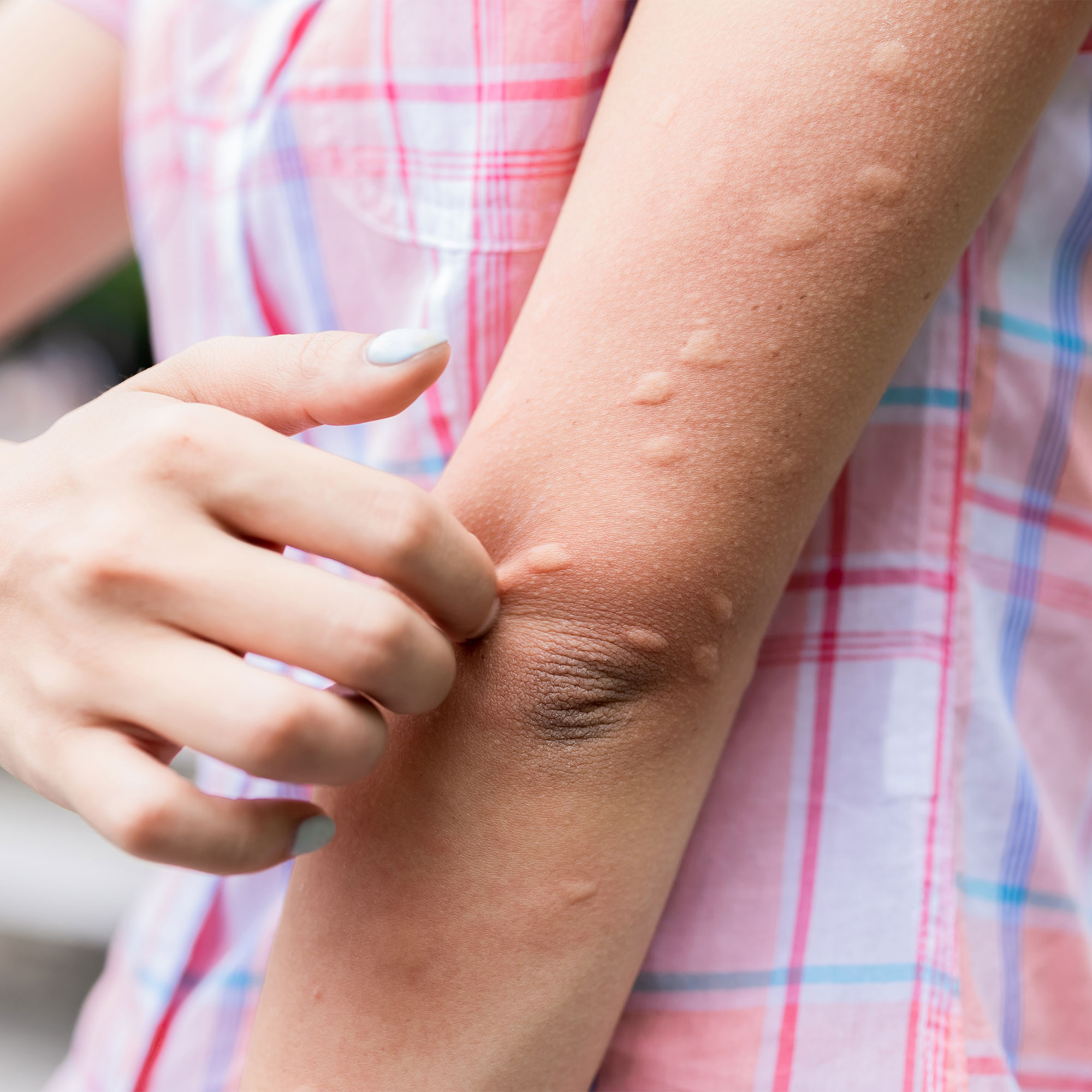 How to Tell the Difference Between Bug Bites, Heat Rash, and Hives