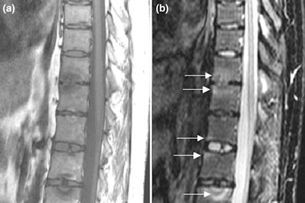 银屑病关节炎的脊柱