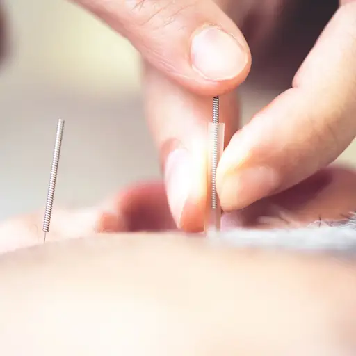 acupuncture