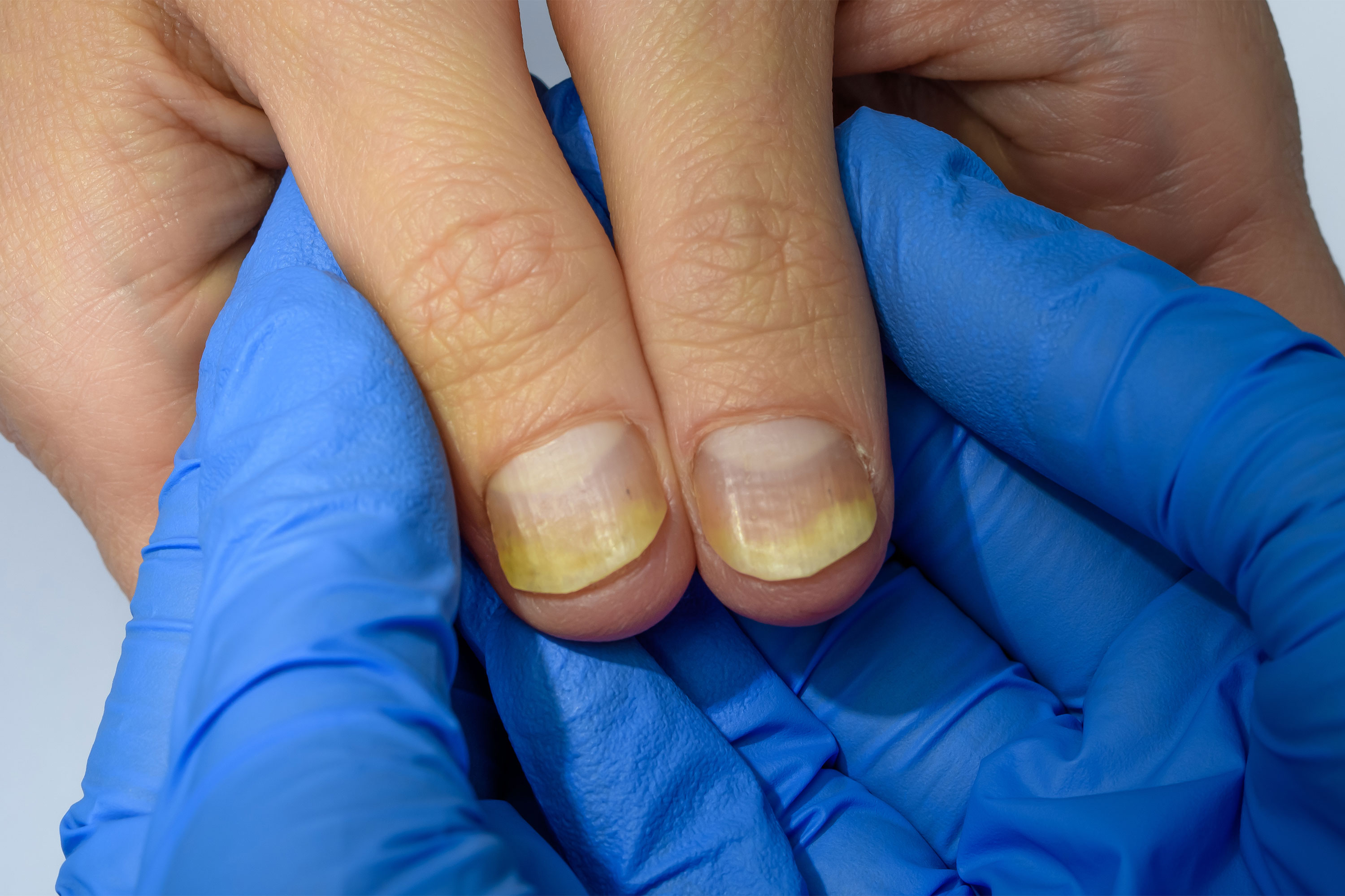 Yellowing, clubbing, plate separation - Sinclair Dermatology