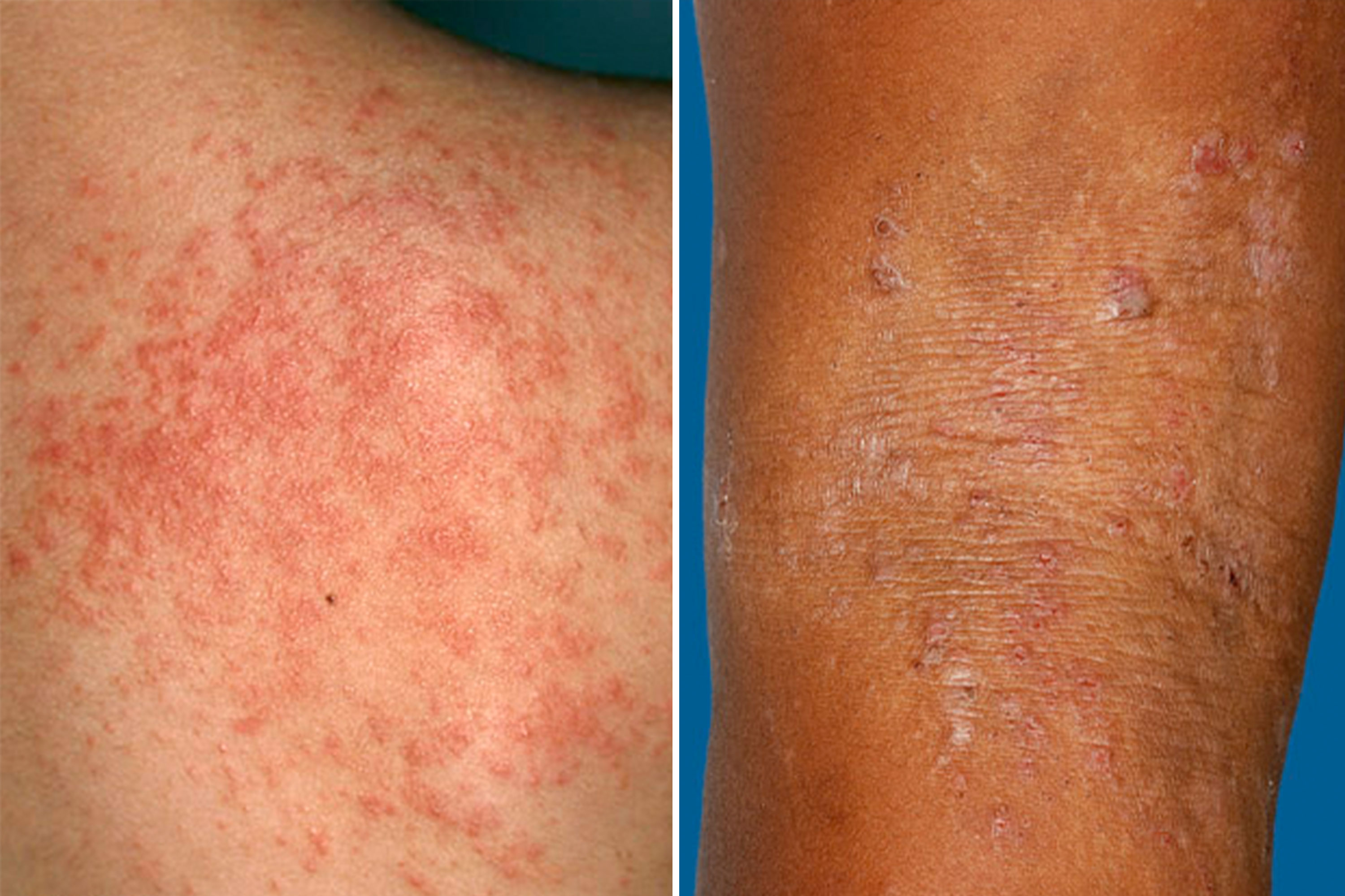 Heat Rash vs. Eczema: What's the Difference?