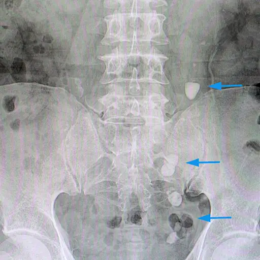 肾结石在输尿管下行驶