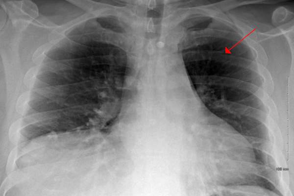 如看到的CXR肋骨骨折
