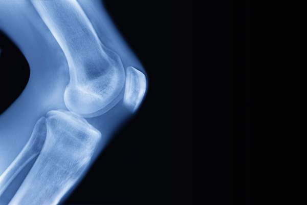 骨关节炎的膝盖