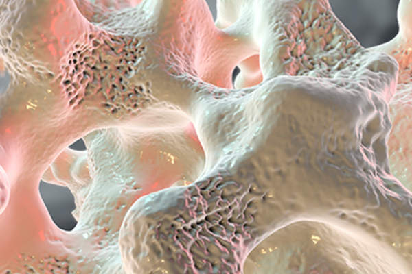 骨质疏松症的症状。