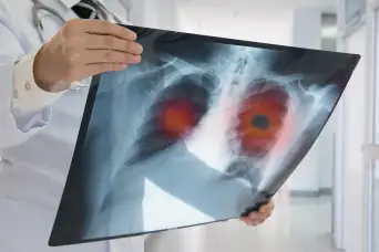 肺癌扫描