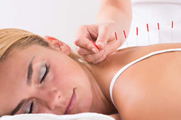 年轻女子正在接受针灸。