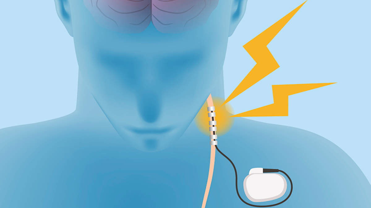 Vagus Nerve Stimulation Shows Promise, but Will it Cure Rheumatoid