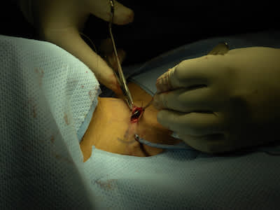 医生颈部手术后缝合起来。